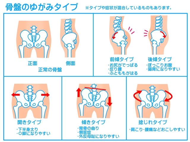 骨盤チェック